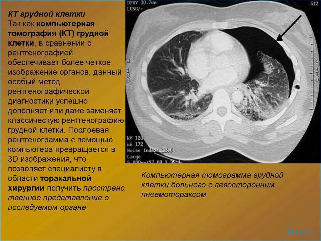 Компьютерная томография органов грудной клетки — преимущества и возможности диагностики патологий легких и сердца